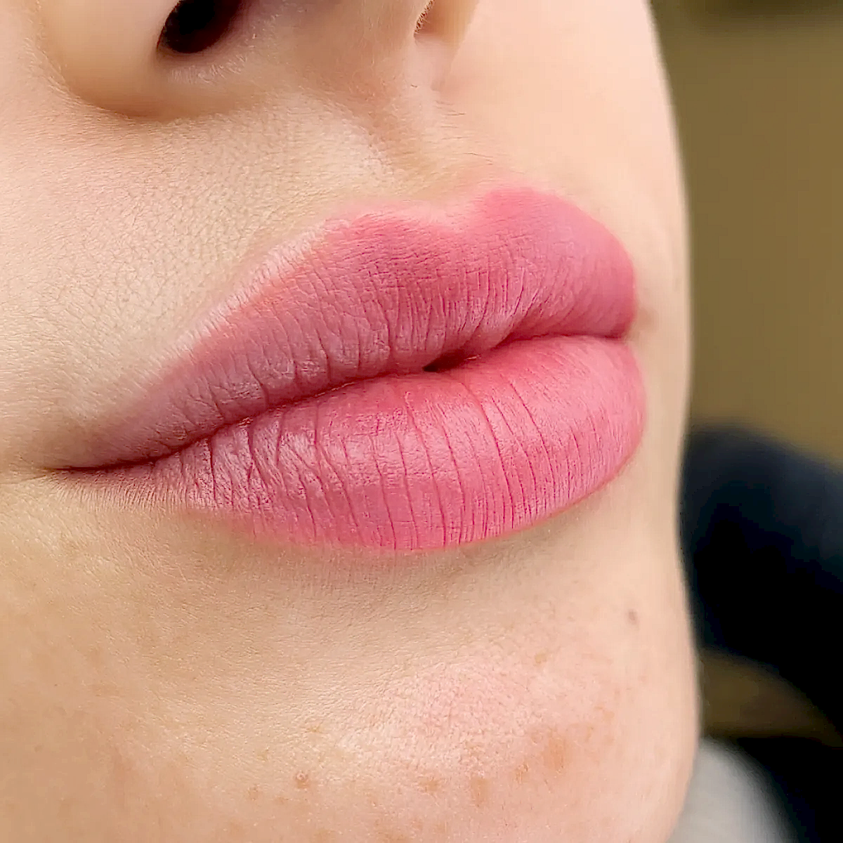 Dudak Gençleştirme