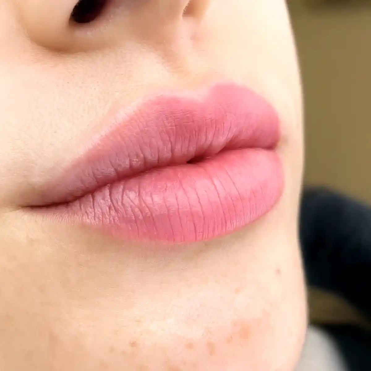 Dudak Gençleştirme